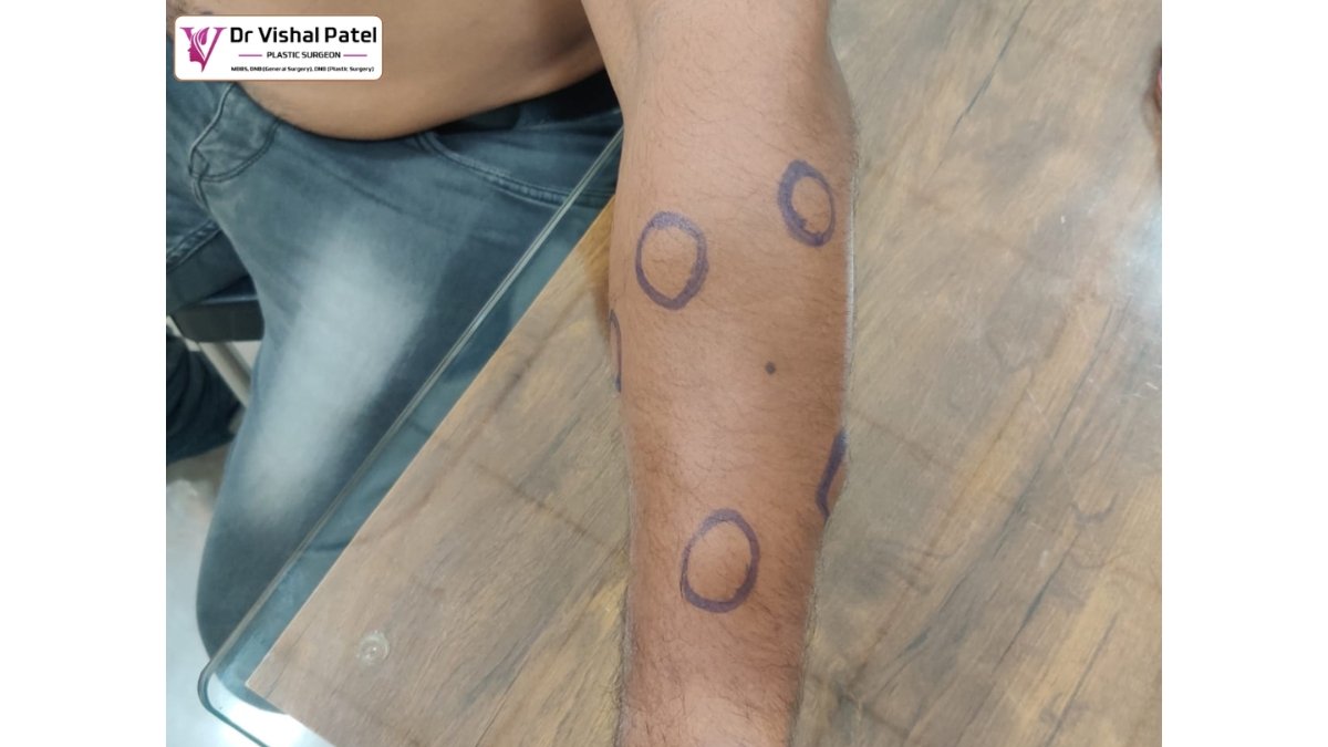 Rare Case of 30+ Multiple Lipomas in Mumbai Treated at Recon Plastic Surgery & Physiotherapy Clinic, Mumbai -PNN